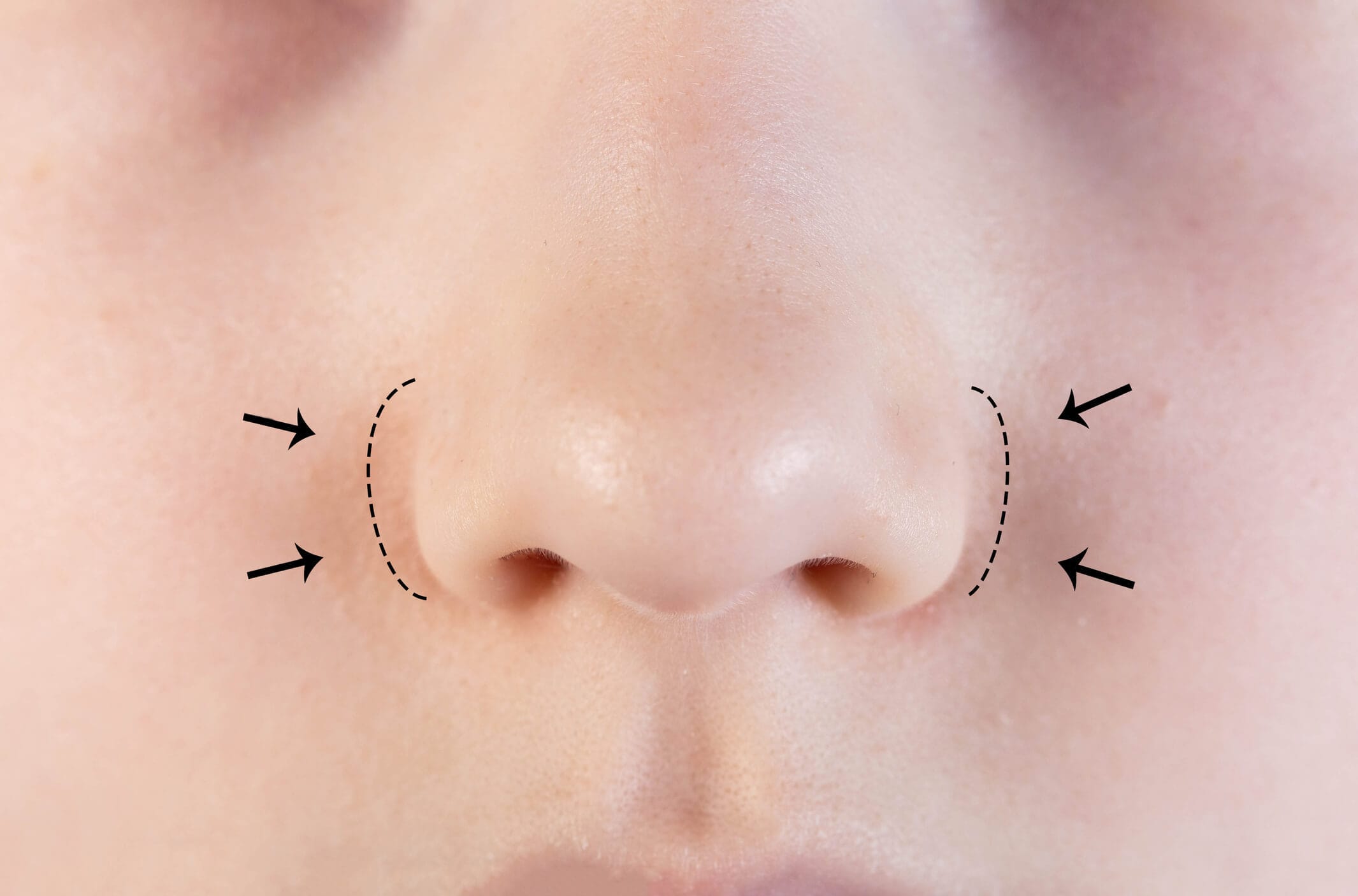 A natural, unaltered nose showcased for rhinoplasty consultation with Dr. George Brennan in Newport Beach, California.