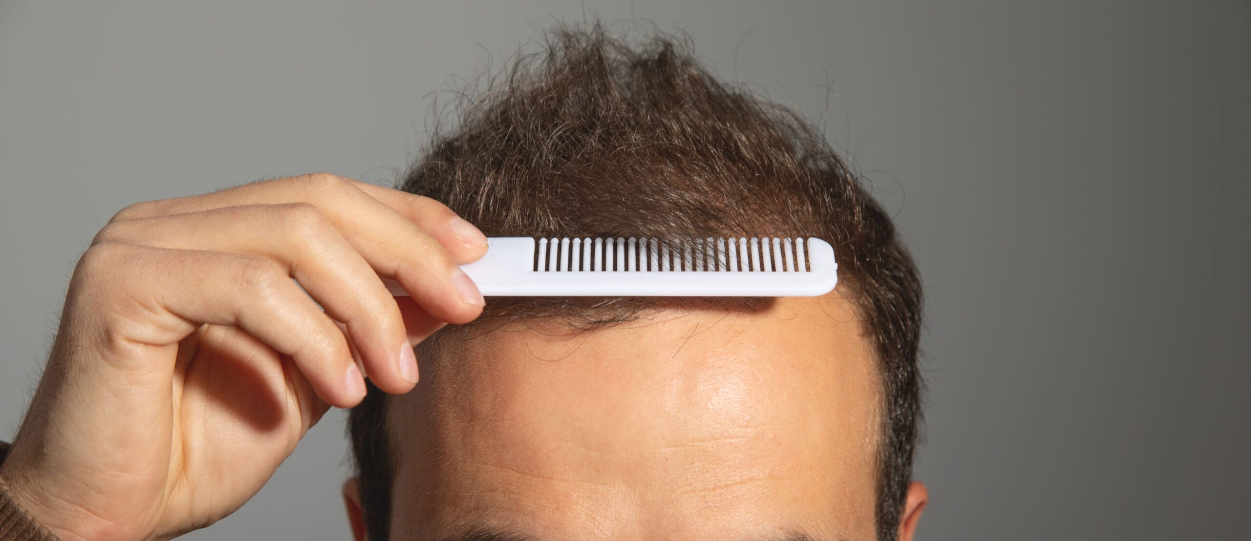 Client who is combating hair loss need a Neograft Hair Transplantation in Newport Beach, California at Dr. George Brennan's Clinic