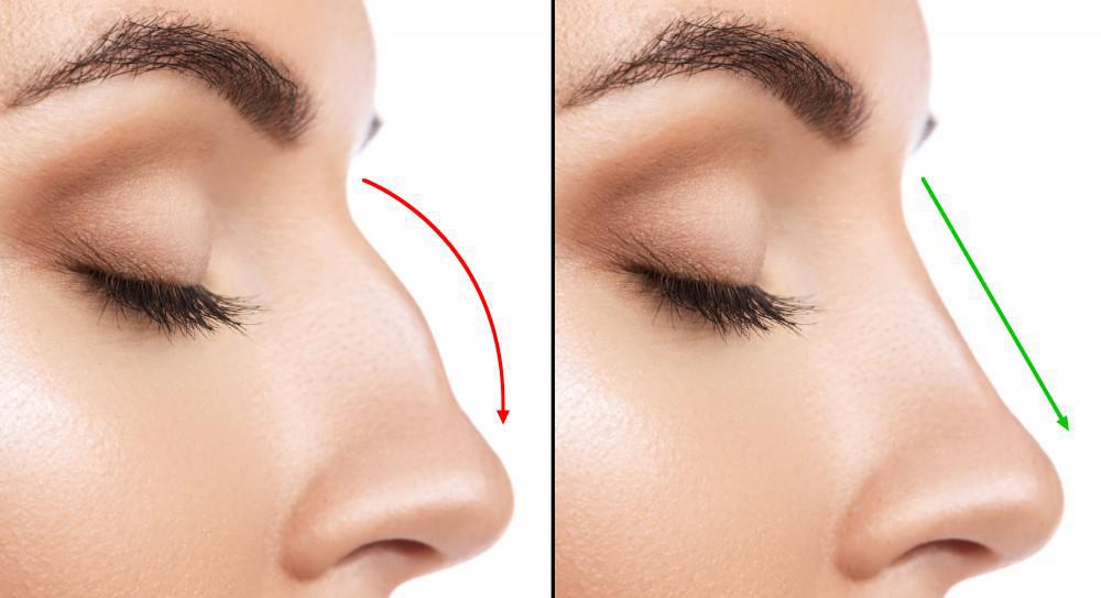 A woman's nose with an arrow pointing to the right.
