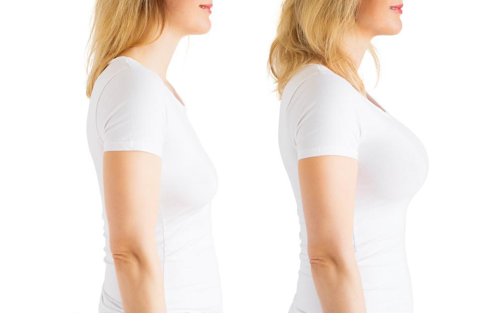 Patient Before and After of Breast Augmentation in Newport Beach, CA at Dr. George Brennan Clinic