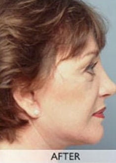 Facelift Procedures