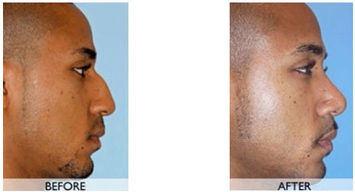 Orange County Rhinoplasty Surgery