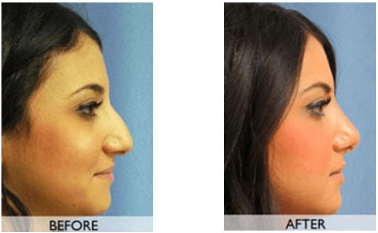 Orange County Rhinoplasty Surgery