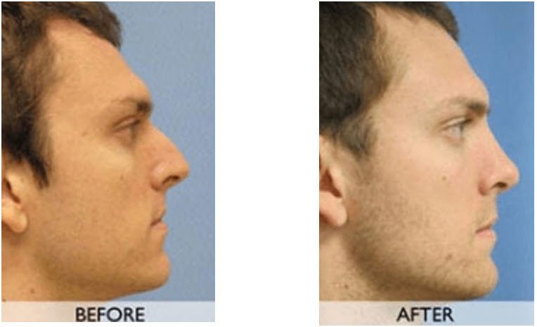 Rhinoplasty before and after