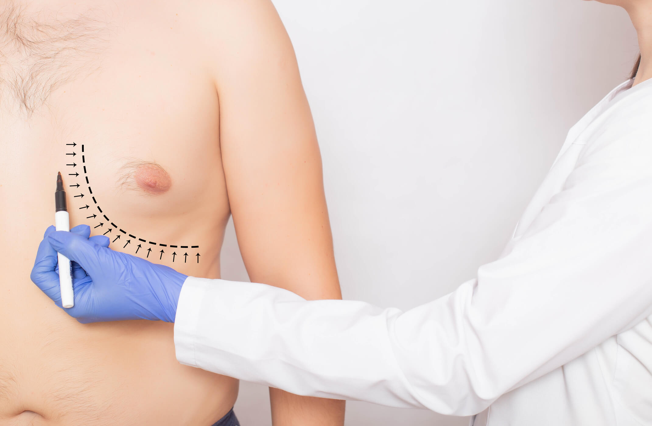 Gynecomastia- Orange County