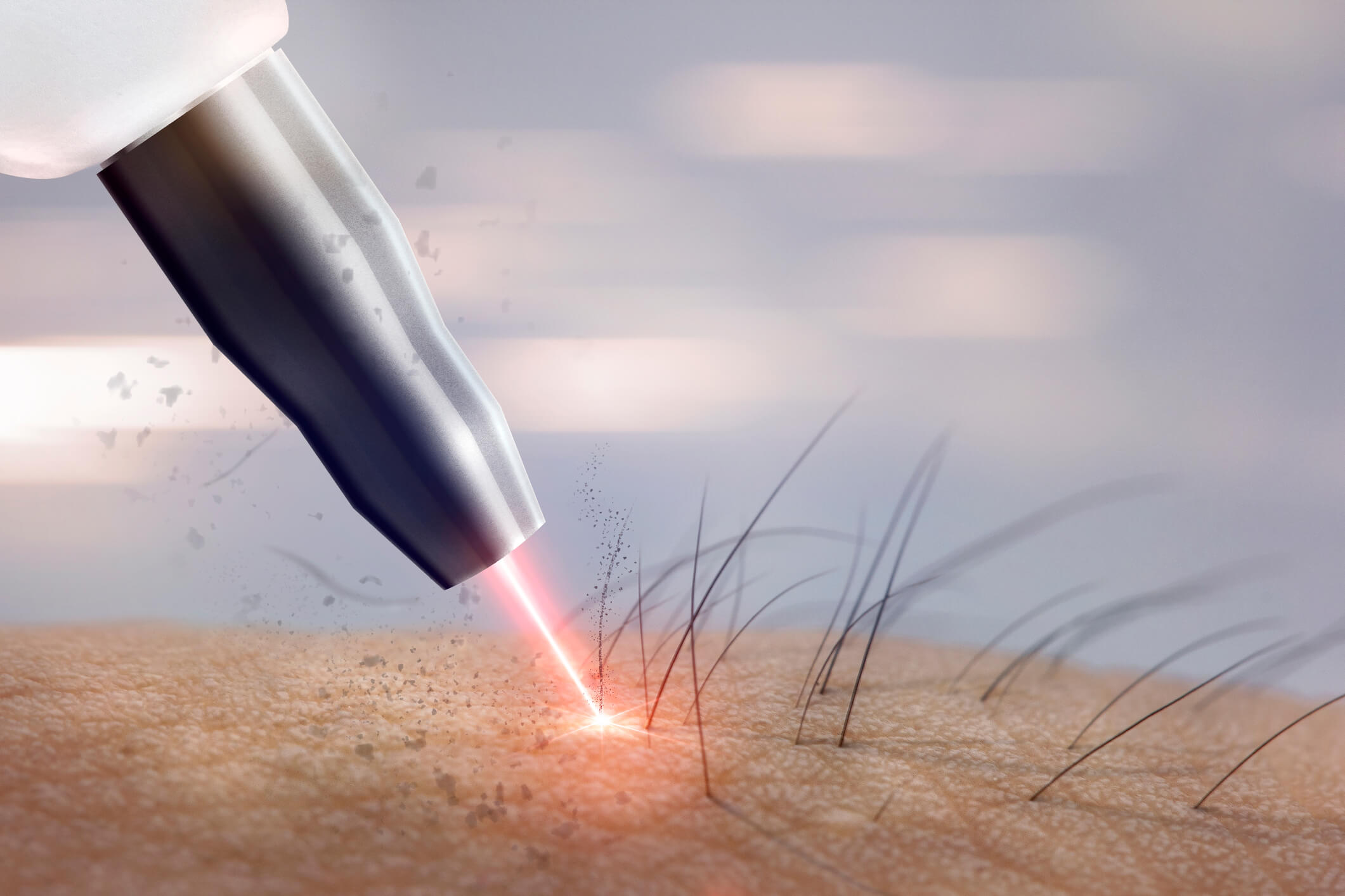 What_Is_Considered_A_Small_Area_For_Laser_Hair_Removal