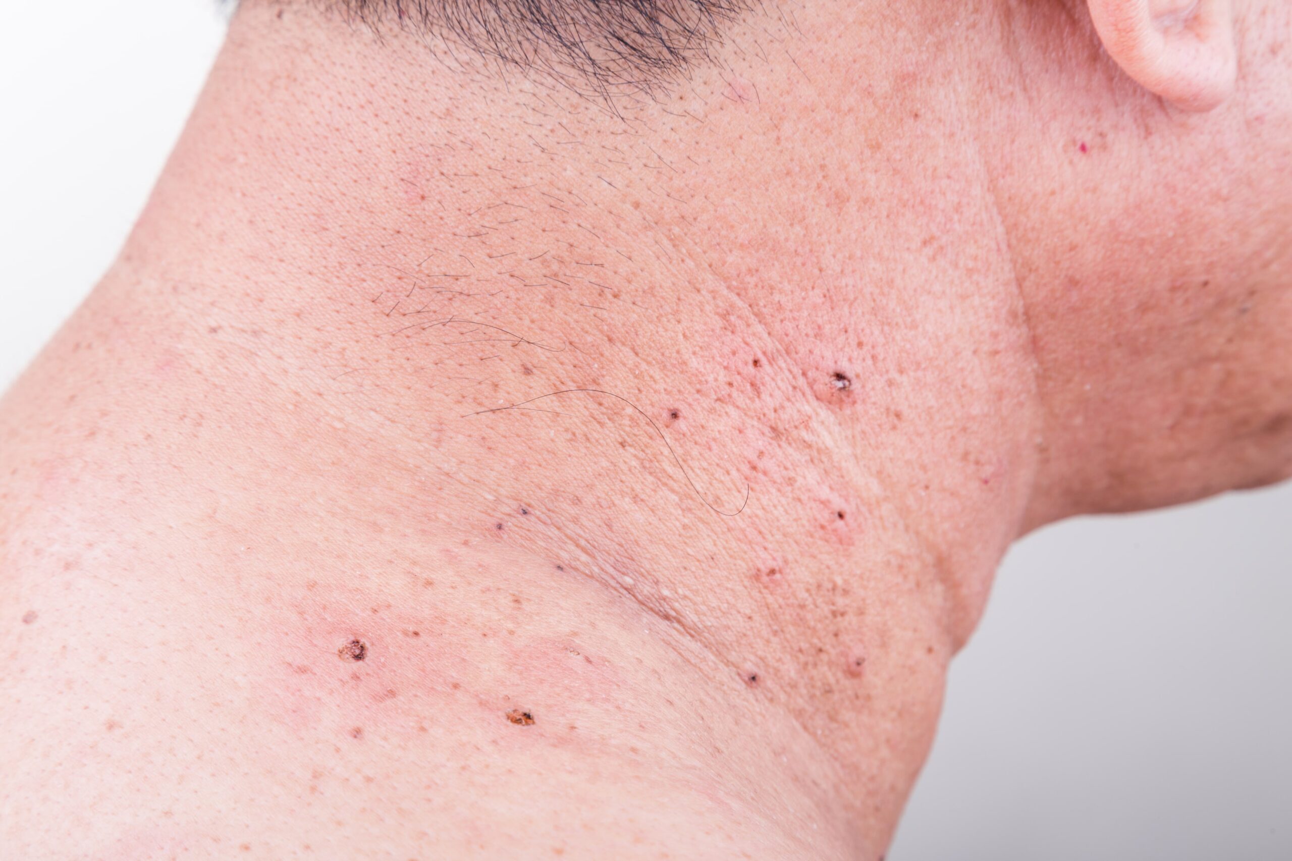 Mole Removal