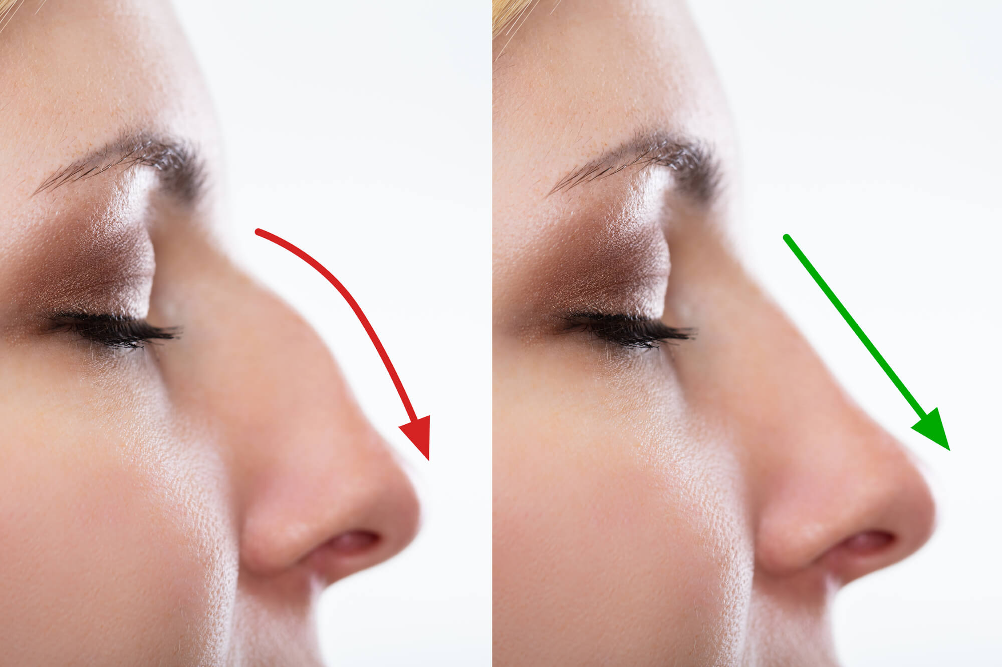 Benefits of Rhinoplasty