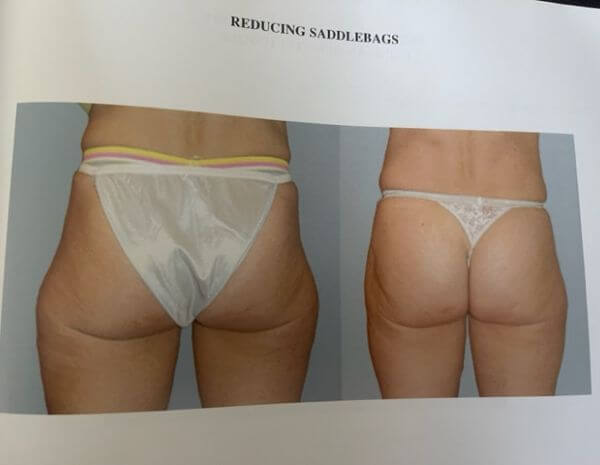 Liposuction Newport Beach