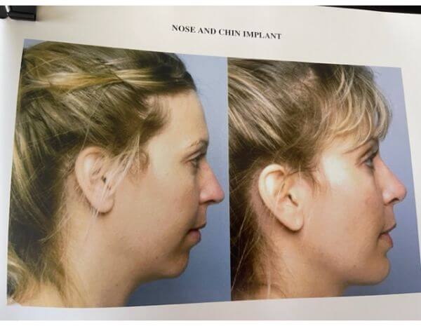 Orange County Rhinoplasty Surgery