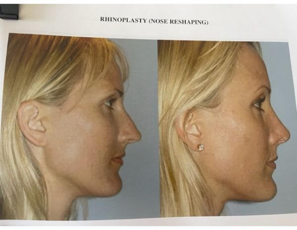 Orange County Rhinoplasty Surgery