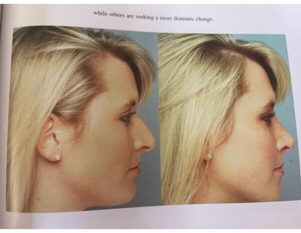 Rhinoplasty Orange County