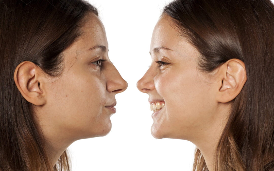 Types of Rhinoplasty