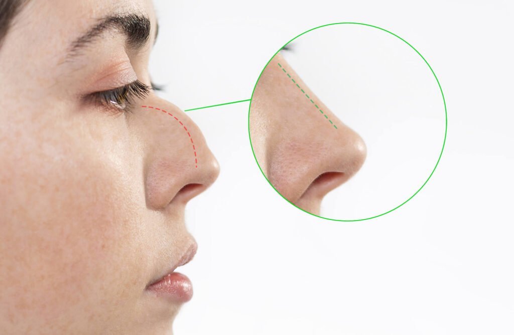 Different Types of Rhinoplasty Surgeries