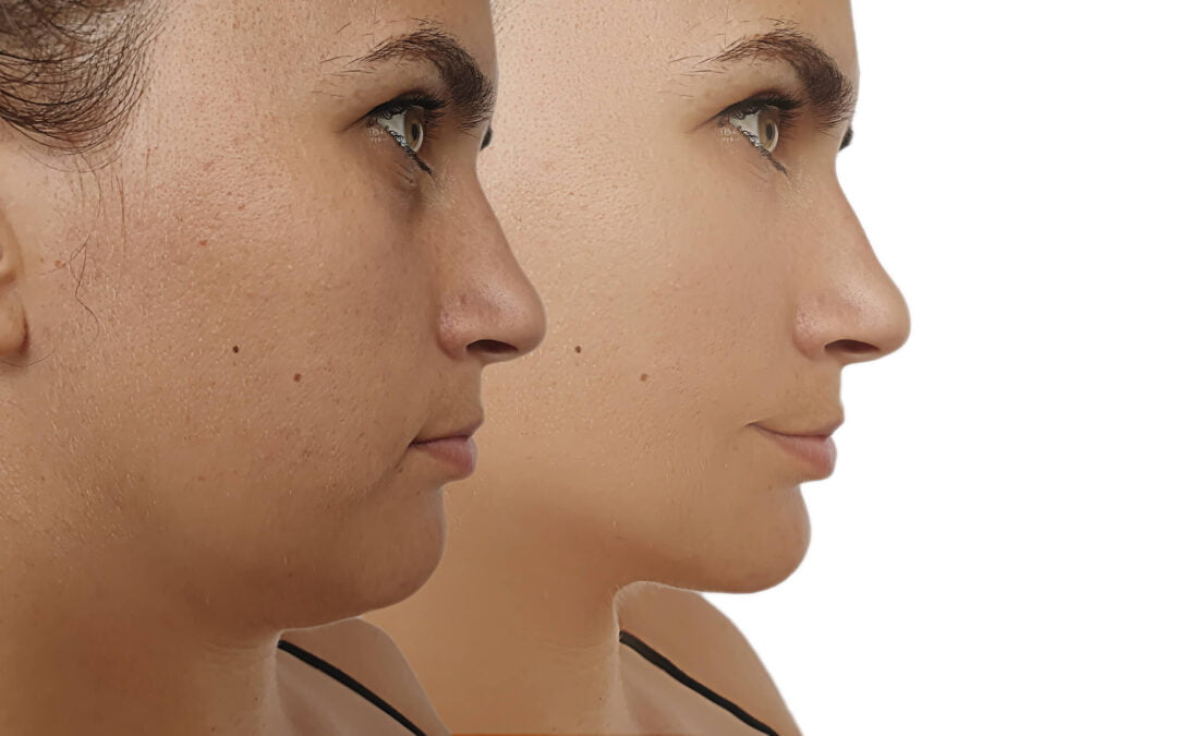 Facelift After Weight Loss