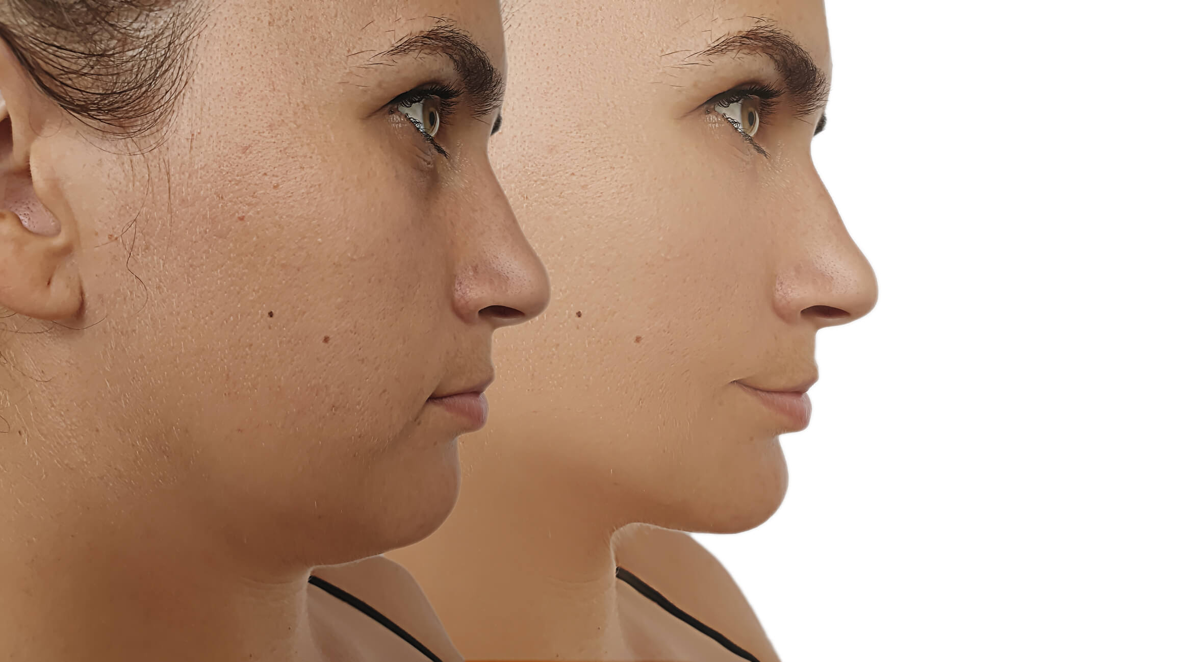 Facelift After Weight Loss