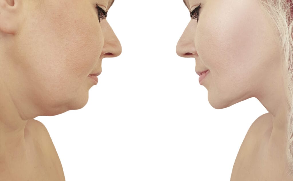 Facelift at 40 consultation with Dr. George Brennan in Newport Beach, California.