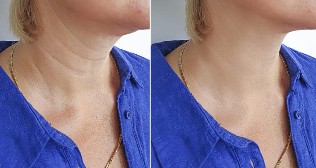 Neck wrinkles treatment through facelift surgery by Dr. George Brennan in Orange County, California.