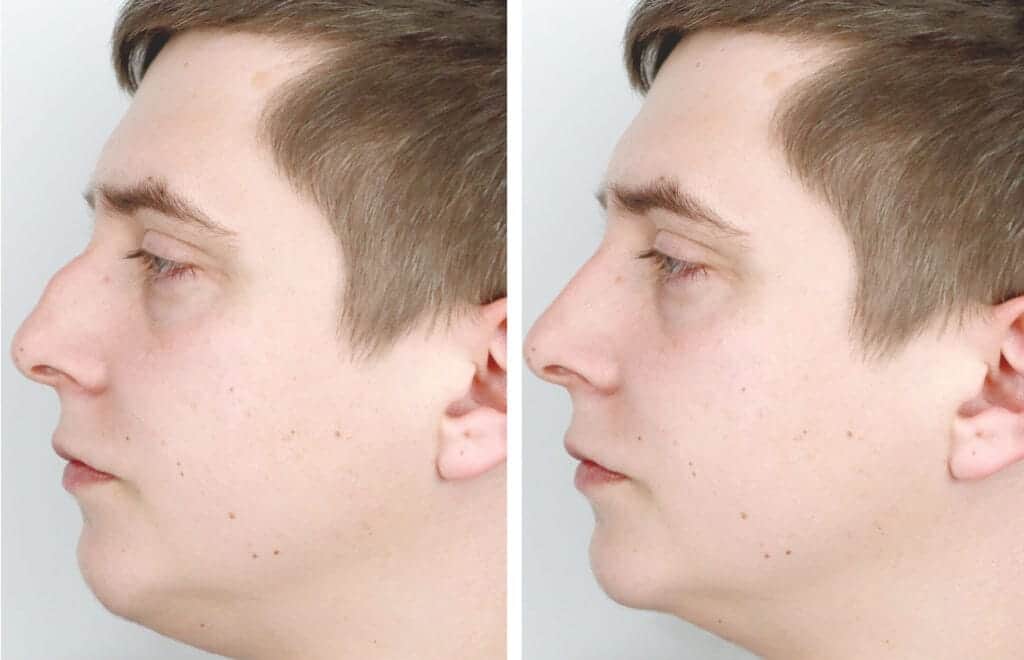 Before and after male rhinoplasty by Dr. George Brennan in Orange County, California.