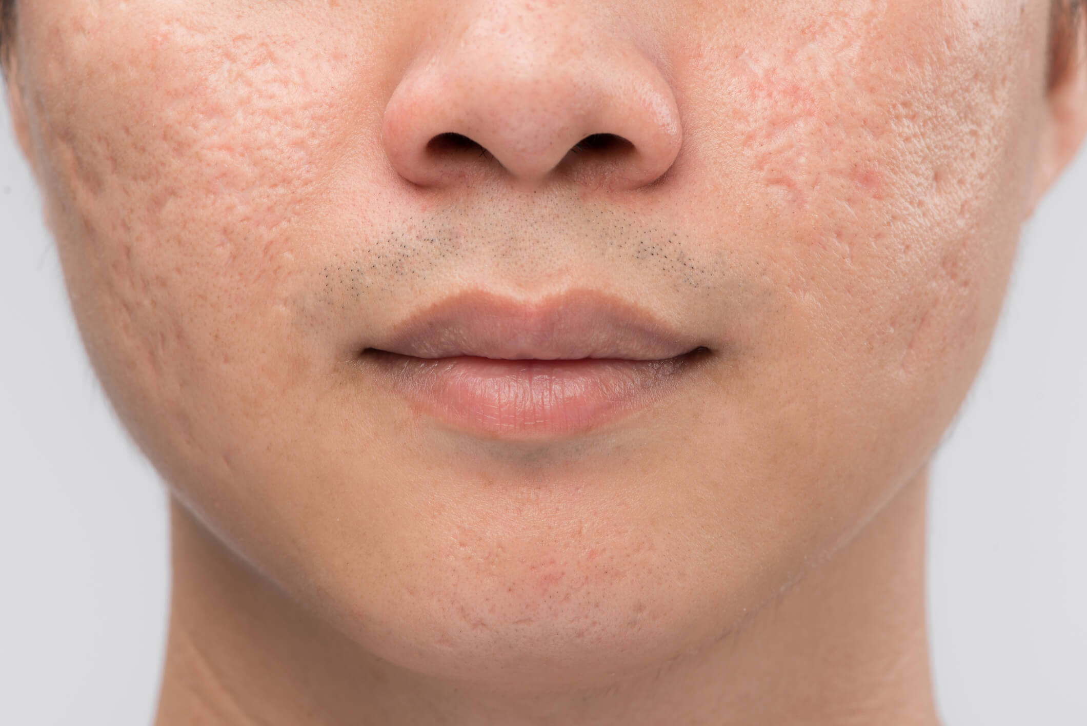 Facelift for acne scars performed by Dr. George Brennan in Orange County California to restore smooth skin.