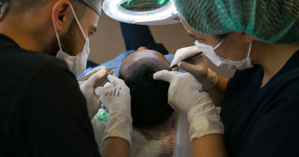 FUE hair transplant procedure performed by a California hair restoration clinic using precise graft placement