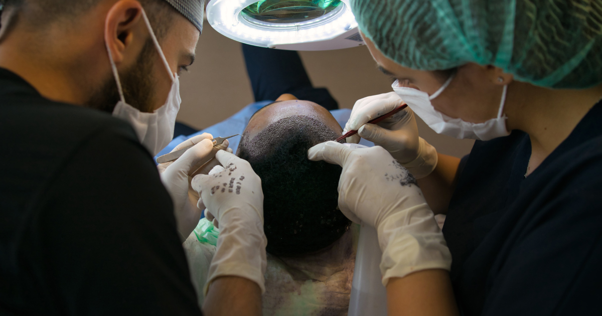 FUE hair transplant procedure performed by a California hair restoration clinic using precise graft placement