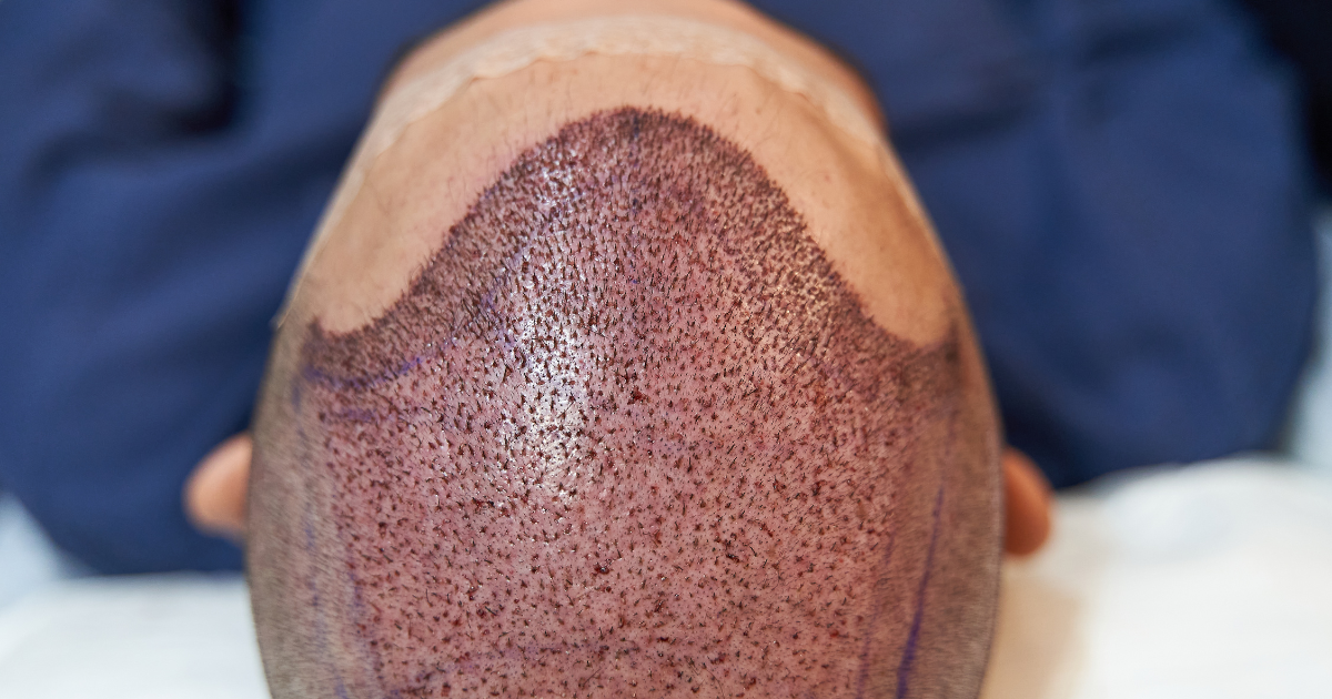 Post FUE hair transplant showing graft placement and natural hairline design in California
