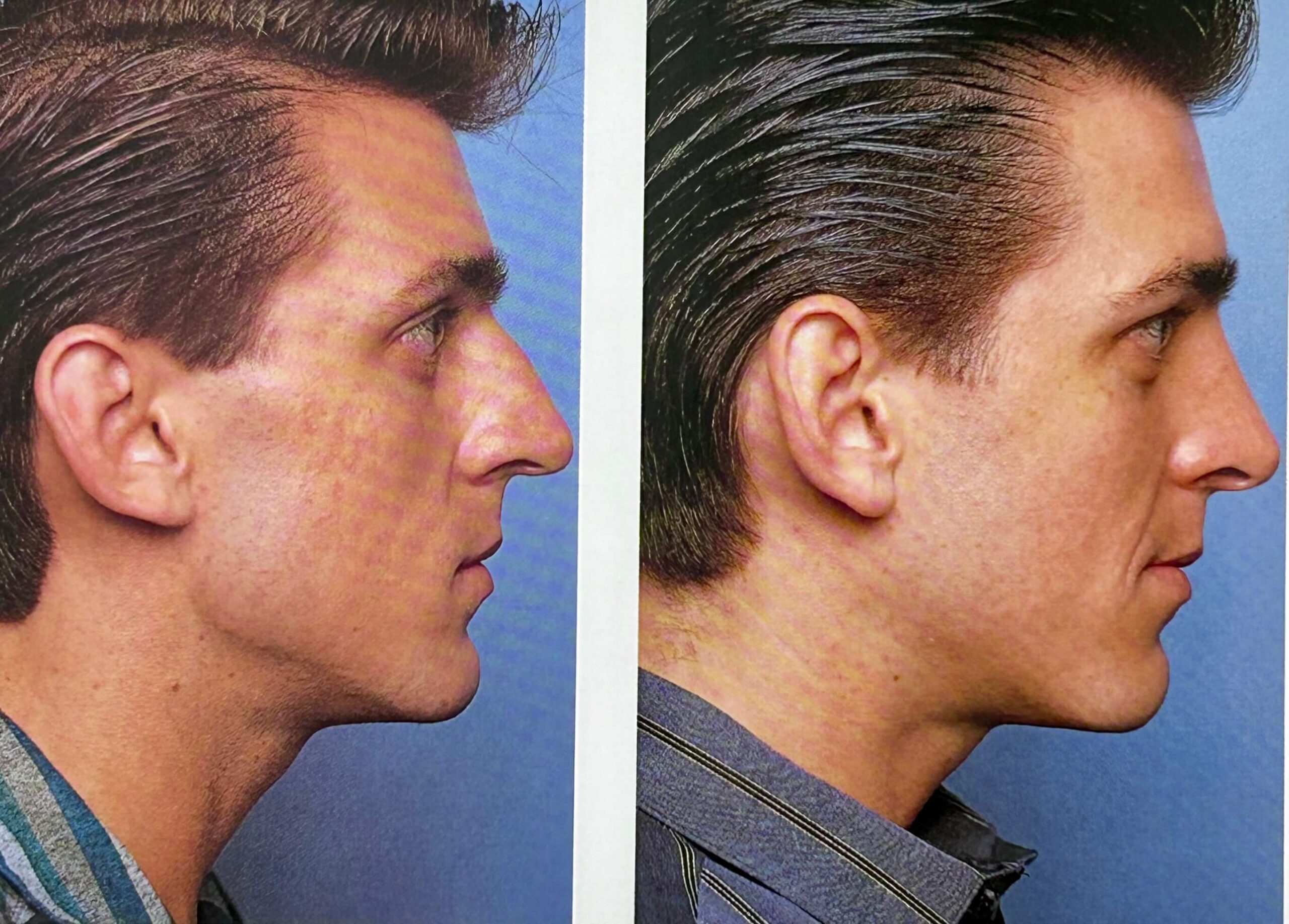 Rhinoplasty surgery by Dr. George Brennan in Orange County, CA for facial refinement Rhinoplasty surgery performed by Dr. George Brennan in Orange County, California, enhancing facial aesthetics