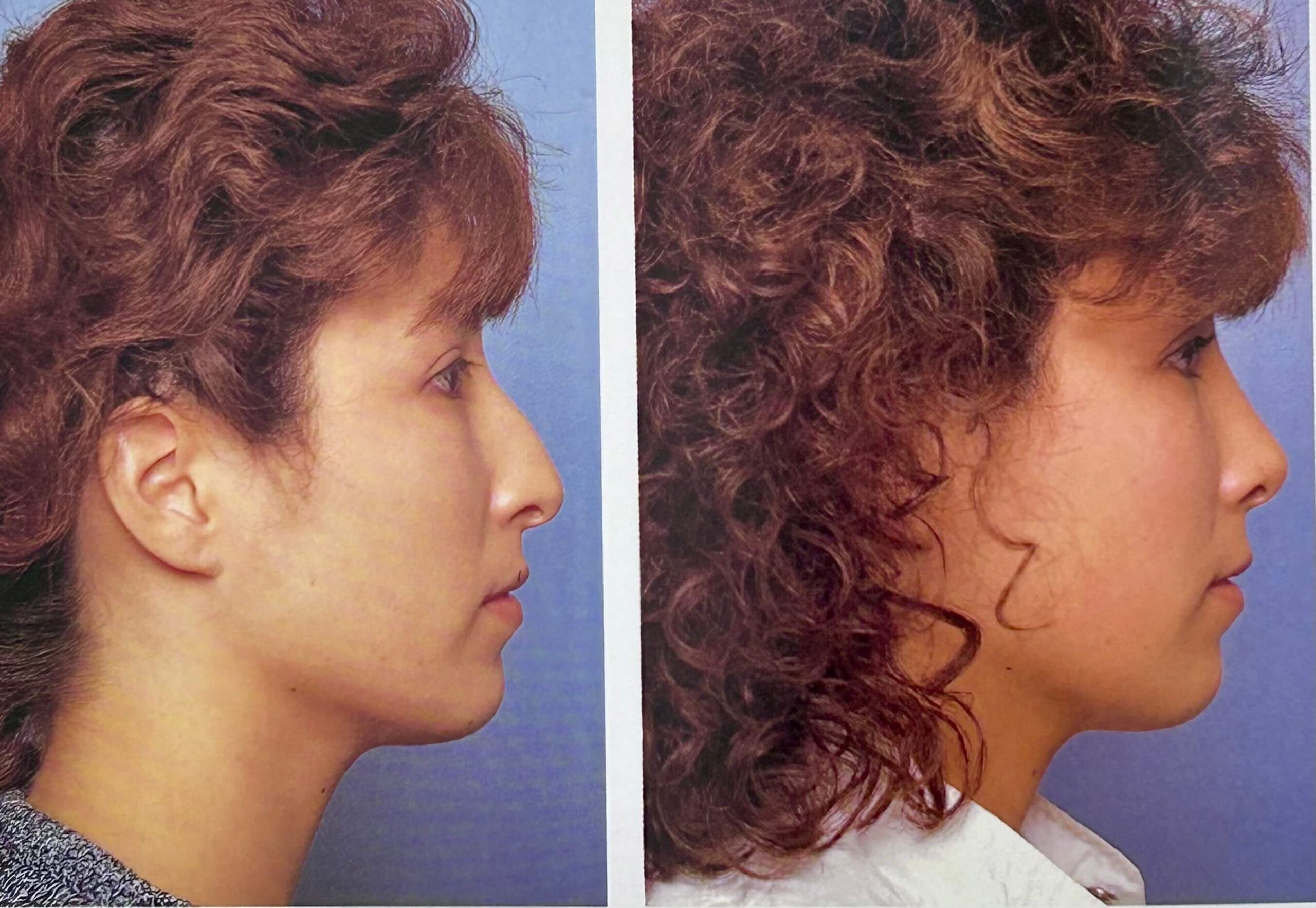 Before and after rhinoplasty results from Dr. George Brennan in Orange County, CA highlighting transformation Before and after rhinoplasty results from Dr. George Brennan in Orange County, CA showing dramatic improvements
