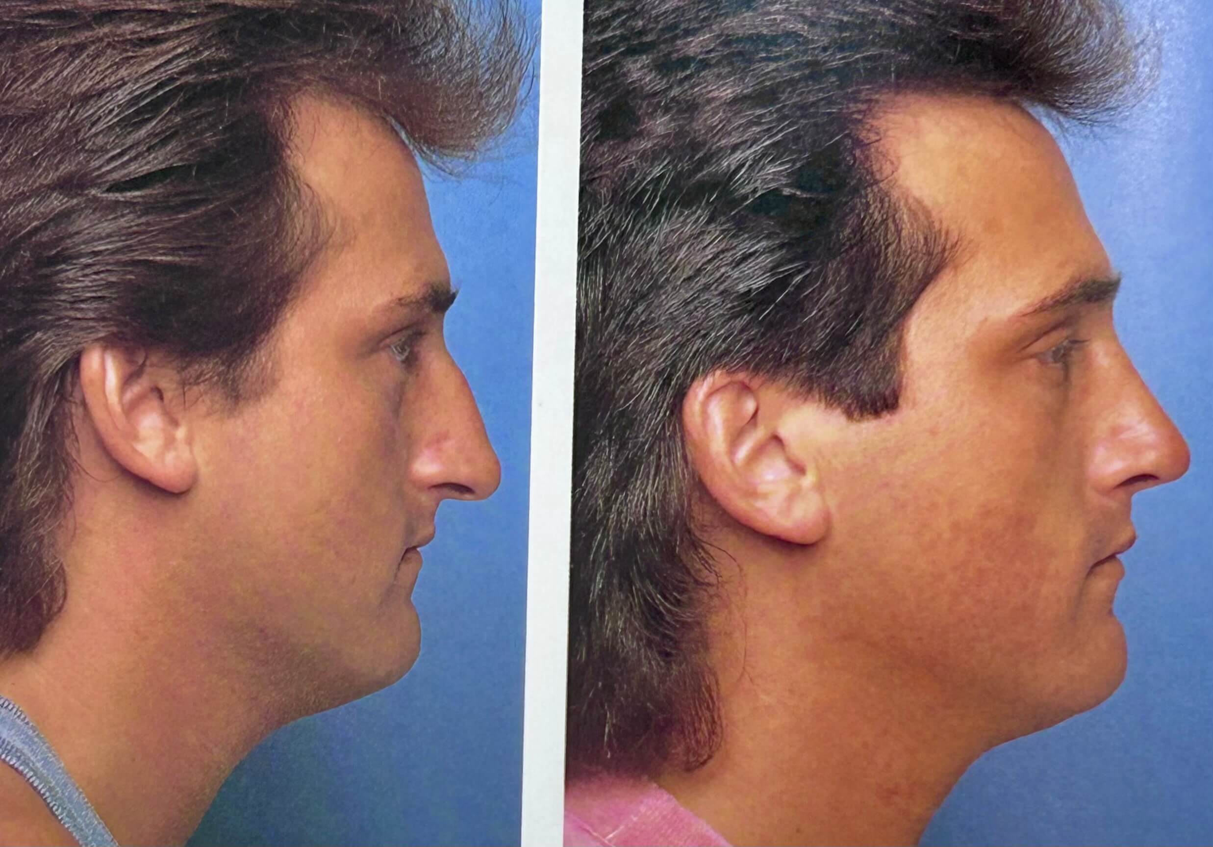 Rhinoplasty consultation with Dr. George Brennan in Orange County, CA discussing treatment options Rhinoplasty consultation with Dr. George Brennan in Orange County, CA for personalized treatment planning