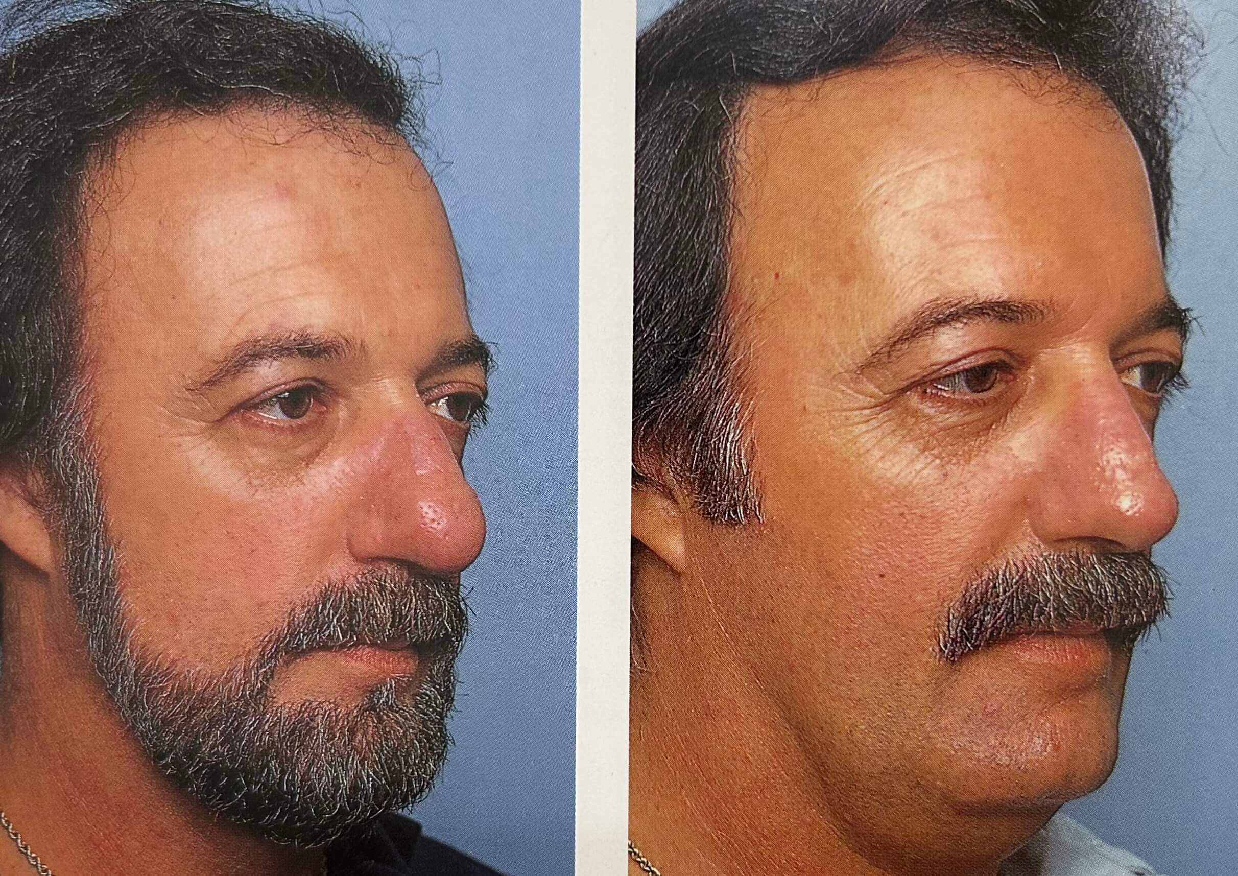 Personalized rhinoplasty consultation with Dr. George Brennan in Orange County, CA for customized results Personalized rhinoplasty consultation with Dr. George Brennan in Orange County, CA, focusing on individual needs