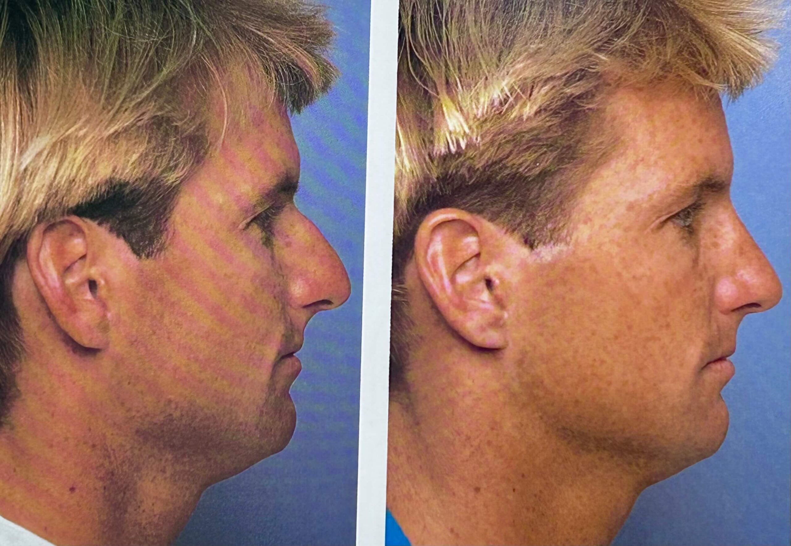 Advanced rhinoplasty techniques with Dr. George Brennan in Orange County, CA for accurate nose reshaping Advanced rhinoplasty techniques by Dr. George Brennan in Orange County, CA for precise nasal reshaping