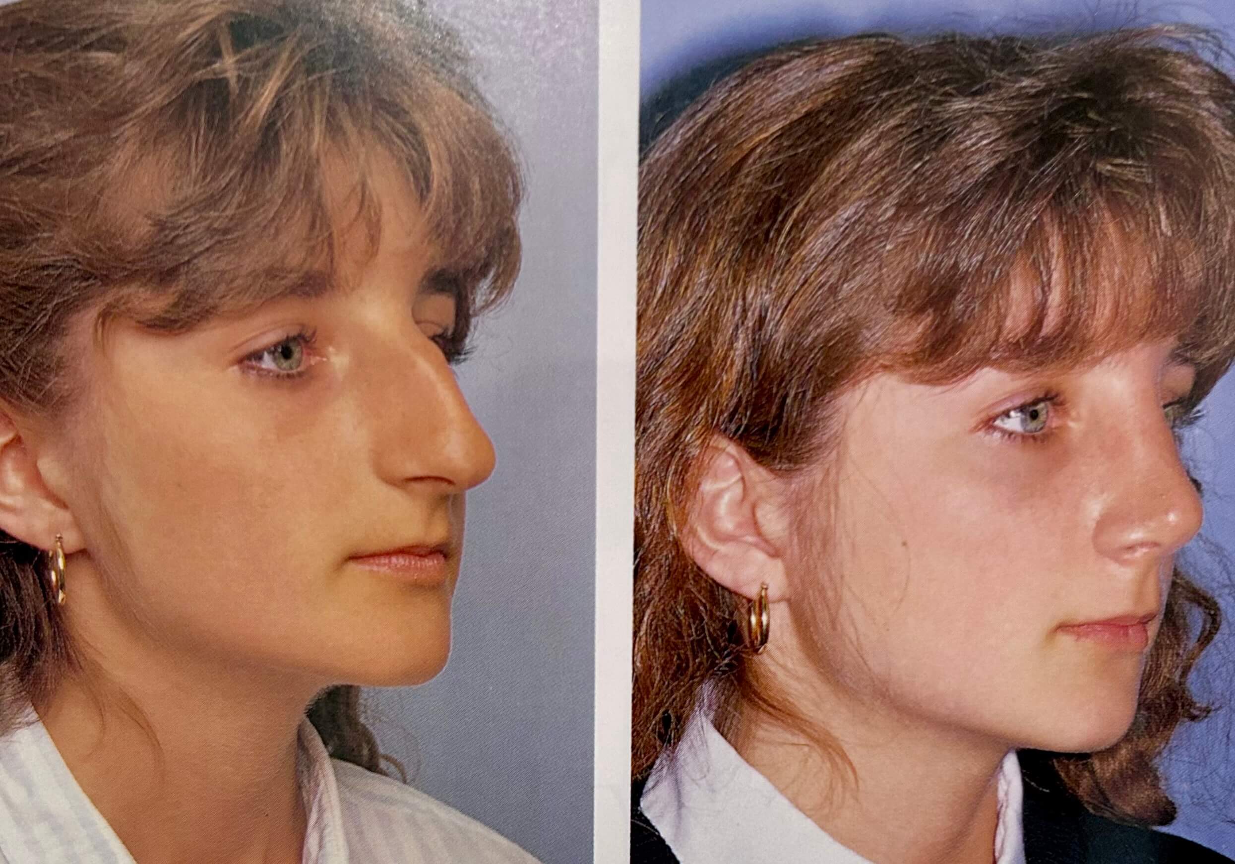 Rhinoplasty by Dr. George Brennan in Orange County, CA creating a refined, balanced nasal profile Rhinoplasty procedure performed by Dr. George Brennan in Orange County, CA for refined nasal shape
