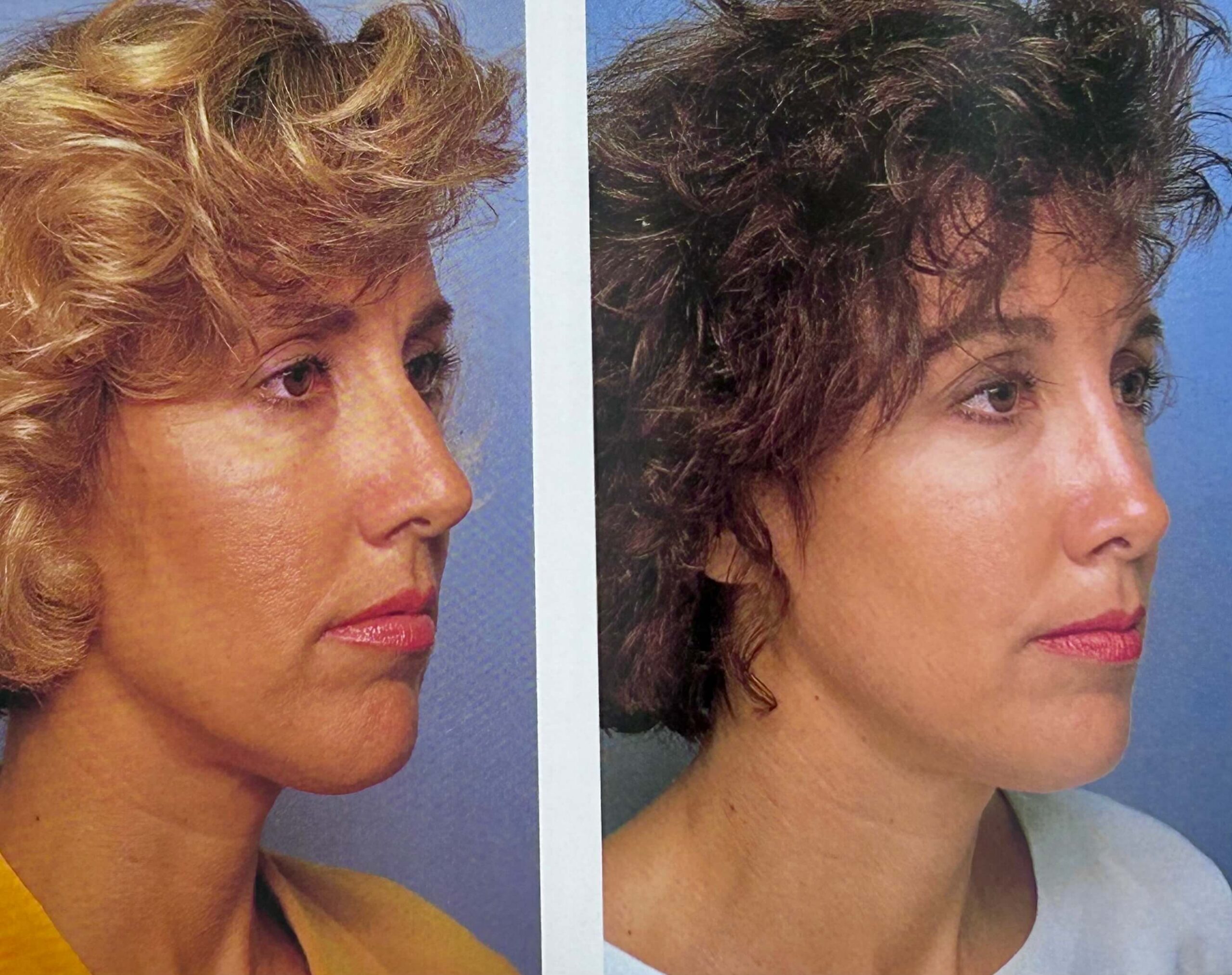 Rhinoplasty recovery tips from Dr. George Brennan in Orange County, CA to ensure effective healing Rhinoplasty recovery tips from Dr. George Brennan in Orange County, CA for smooth healing