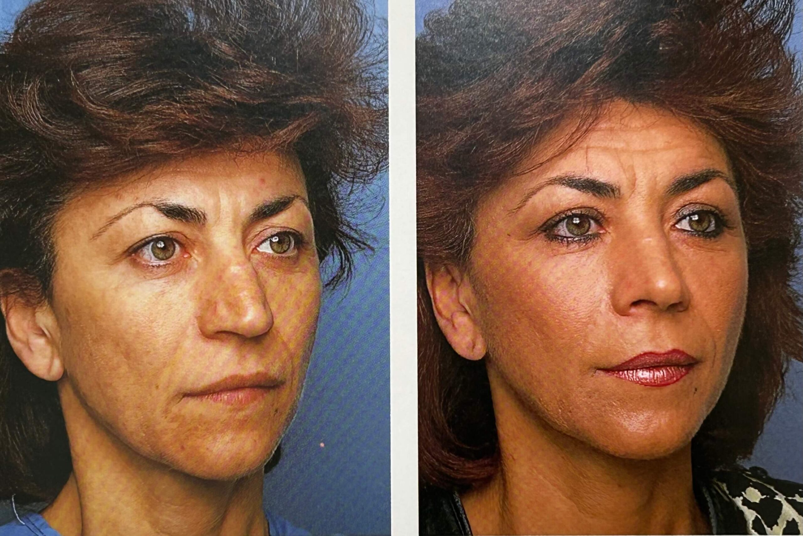 Rhinoplasty patient satisfaction with Dr. George Brennan in Orange County, CA reflecting transformative results Patient satisfaction after rhinoplasty with Dr. George Brennan in Orange County, CA showcasing excellent results