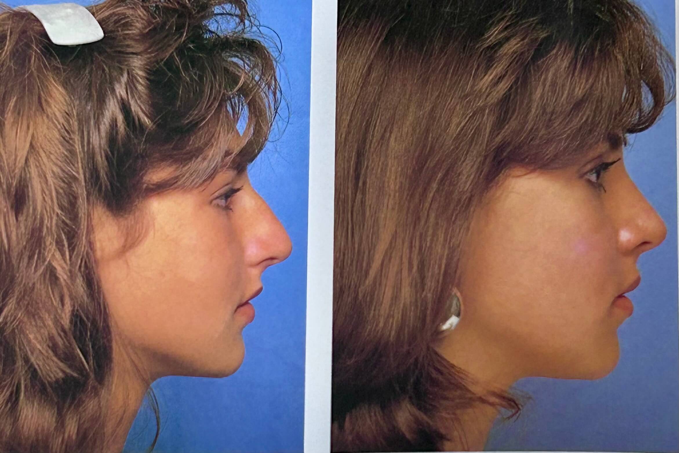 Rhinoplasty procedure by Dr. George Brennan in Orange County, CA for nasal correction and enhancement Rhinoplasty procedure by Dr. George Brennan in Orange County, CA correcting nasal irregularities