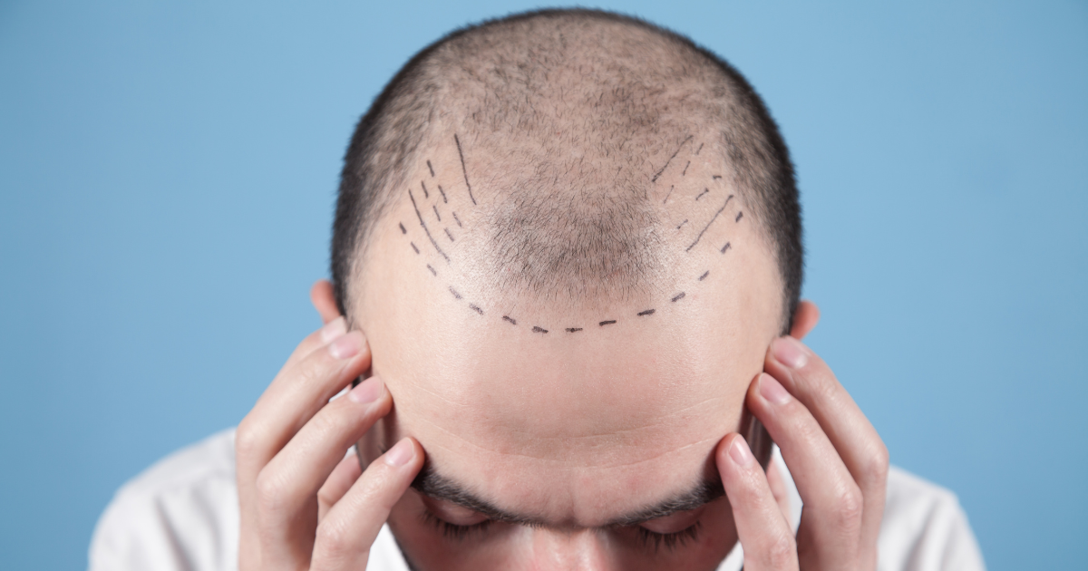 NeoGraft FUE hair transplant planning with precise hairline design at a Newport Beach hair restoration clinic