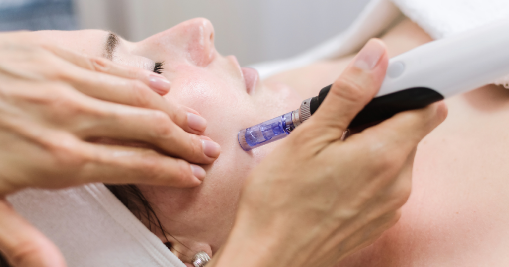 Microneedling skin tightening treatment at a medical spa in Newport Beach to stimulate collagen