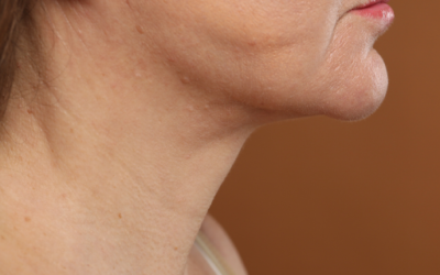 Facelift Newport Beach CA: What Patients Should Know Before Choosing a Surgeon