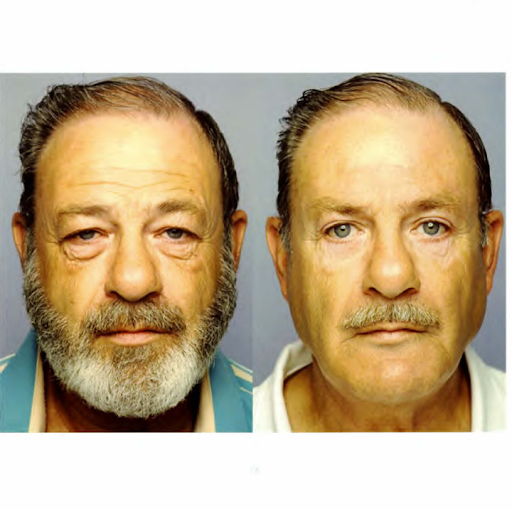 Before and after facial rejuvenation showing improved jawline definition, smoother midface, and a more refreshed appearance after an aging face treatment plan in Newport Beach.