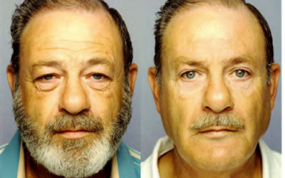 Aging Face Solutions in Newport Beach: Comparing Surgical and Non Surgical Options