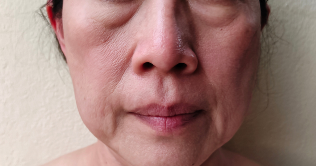 Close up of facial aging around mouth and jawline often treated with Deep Plane Facelift in Newport Beach