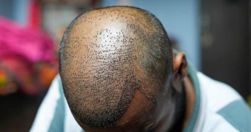 Close up of scalp after hair transplant procedure showing newly implanted hair grafts for hair restoration