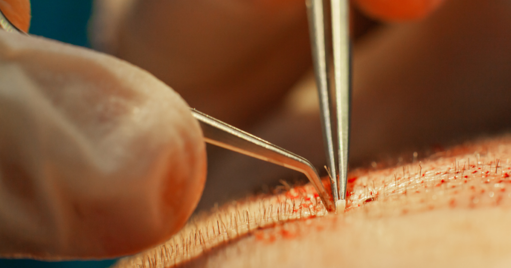 Hair transplant procedure placing follicle grafts during hair restoration treatment at a Newport Beach hair restoration clinic