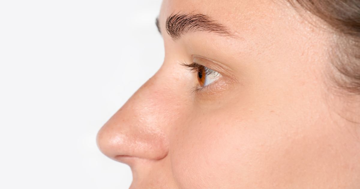 Patient side profile showing nasal hump and facial proportions during rhinoplasty consultation with a rhinoplasty surgeon in California specializing in natural nose refinement.