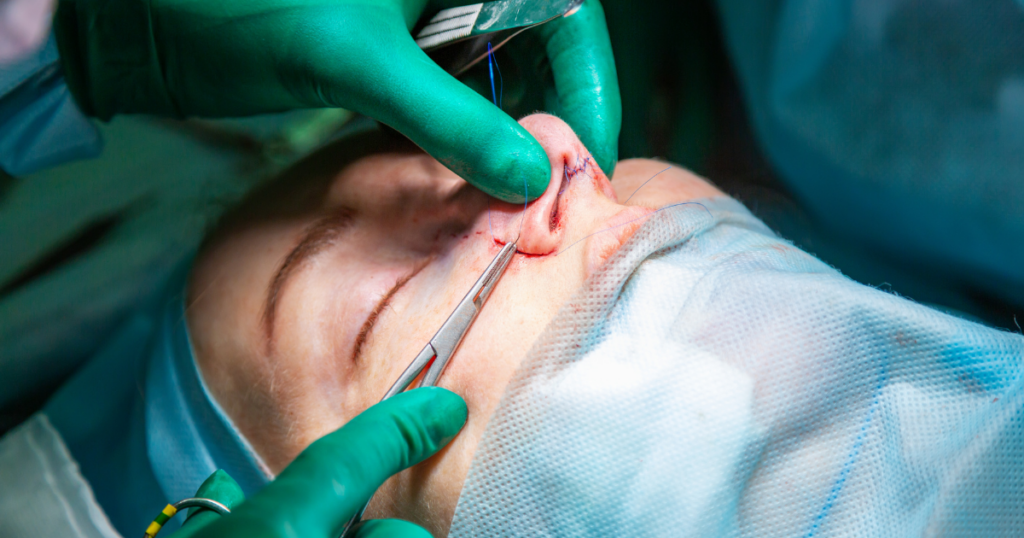 Surgeon performing rhinoplasty surgery to reshape the nose during a cosmetic nose refinement procedure by a rhinoplasty surgeon in California.