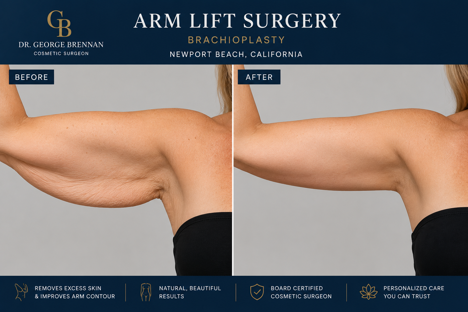 Dr. George Brennan discussing arm lift surgery and brachioplasty options in Newport Beach, California.