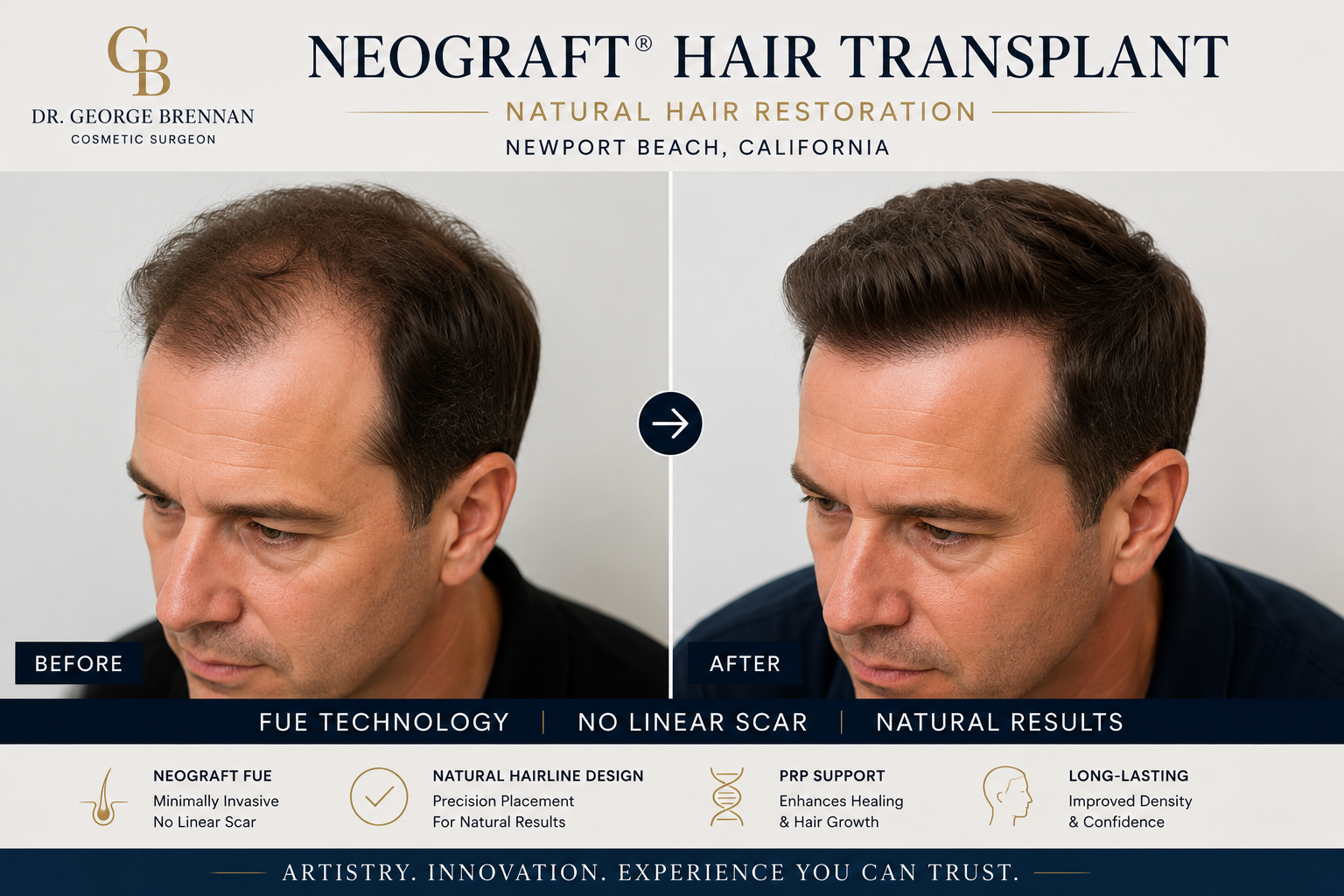 Dr. George Brennan discussing NeoGraft hair transplant and natural hair restoration options in Newport Beach.